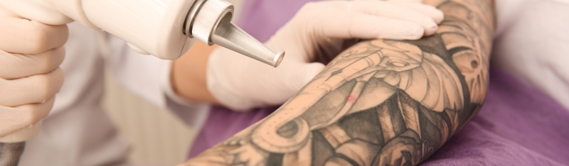 Post tattoo removal revitalisation skin therapy showing calm healing skin after laser removal