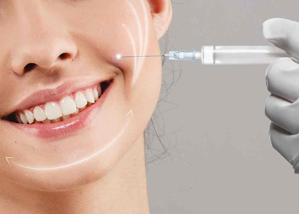 smile-lines-filler-smile-lines-treatment-diamond-skin