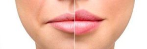 Lip Fillers